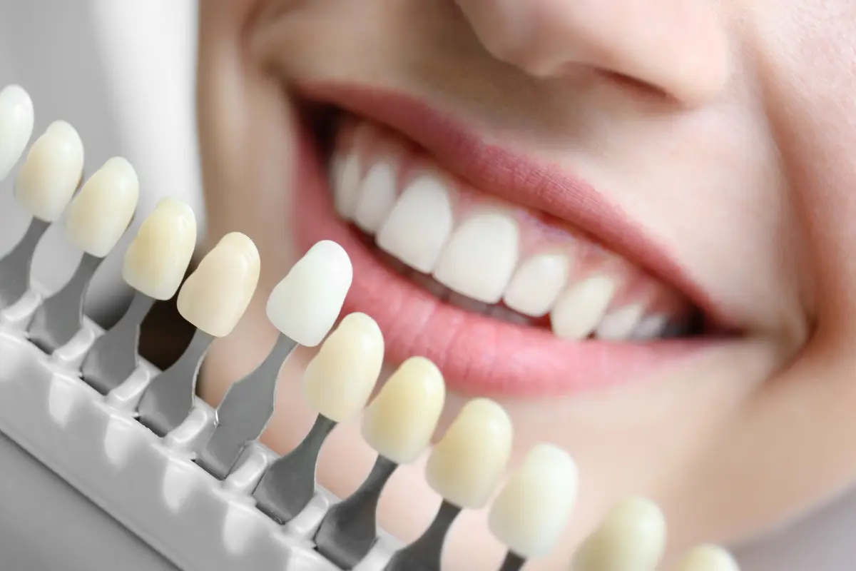 Aplicación de gel para un tratamiento de blanqueamiento dental