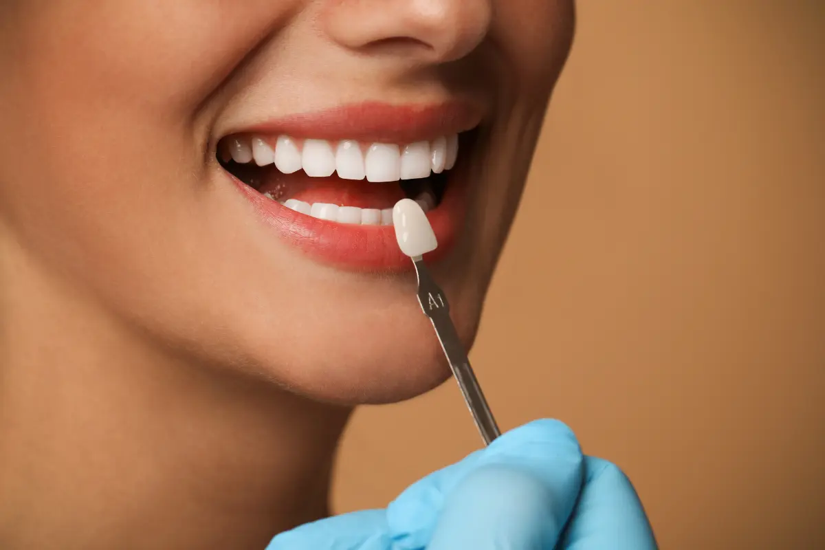 Selección del tono para unas carillas dentales