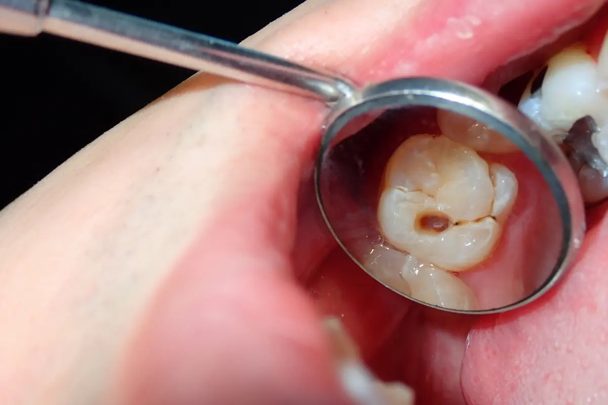Procedimiento de cirugía oral en una pieza dental