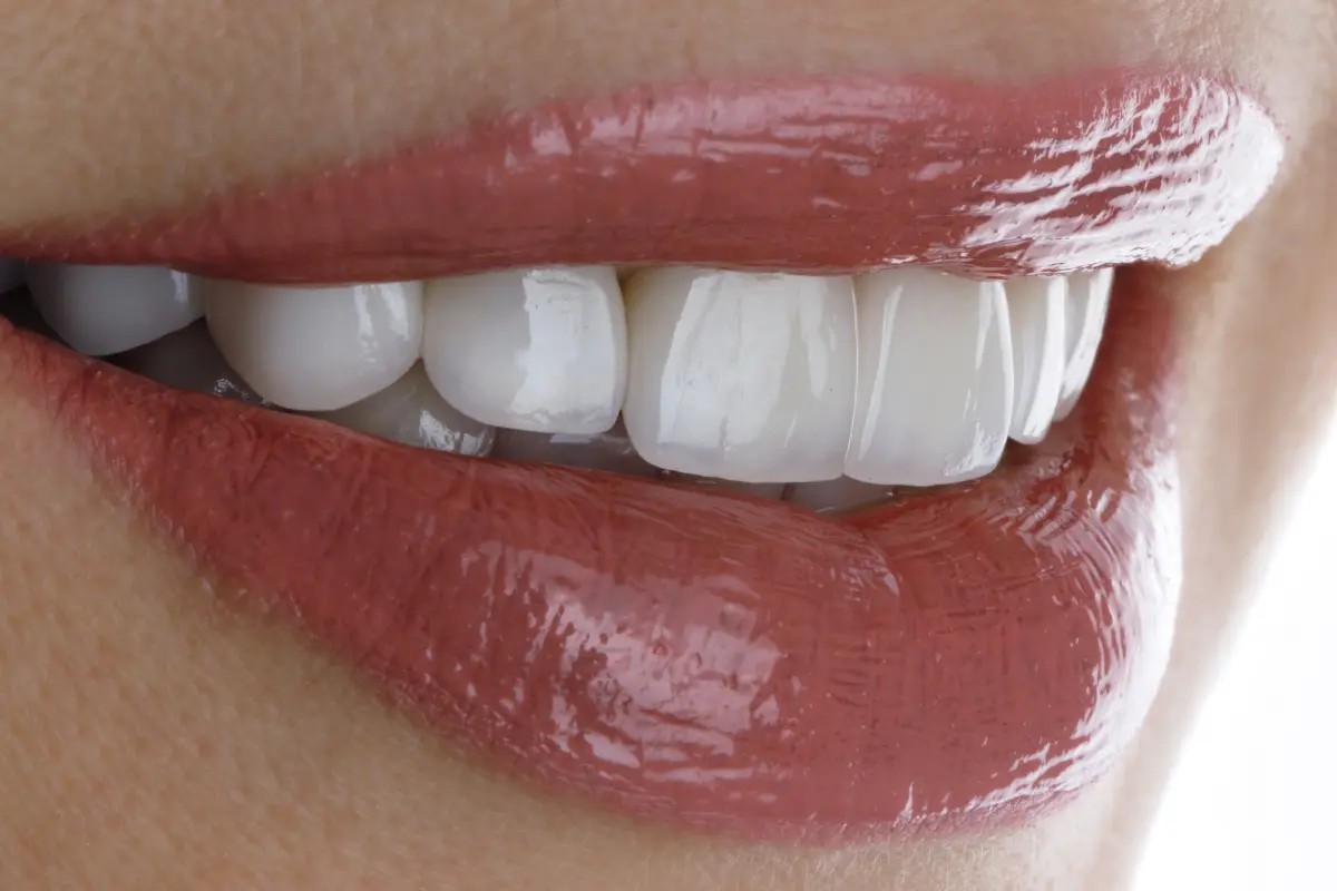 Sonrisa con carillas o restauraciones de estética dental