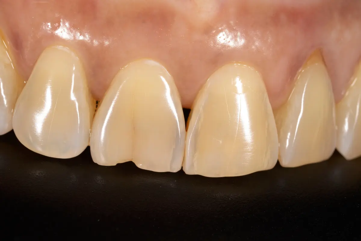 Dientes con desgaste relacionado con hábitos orales