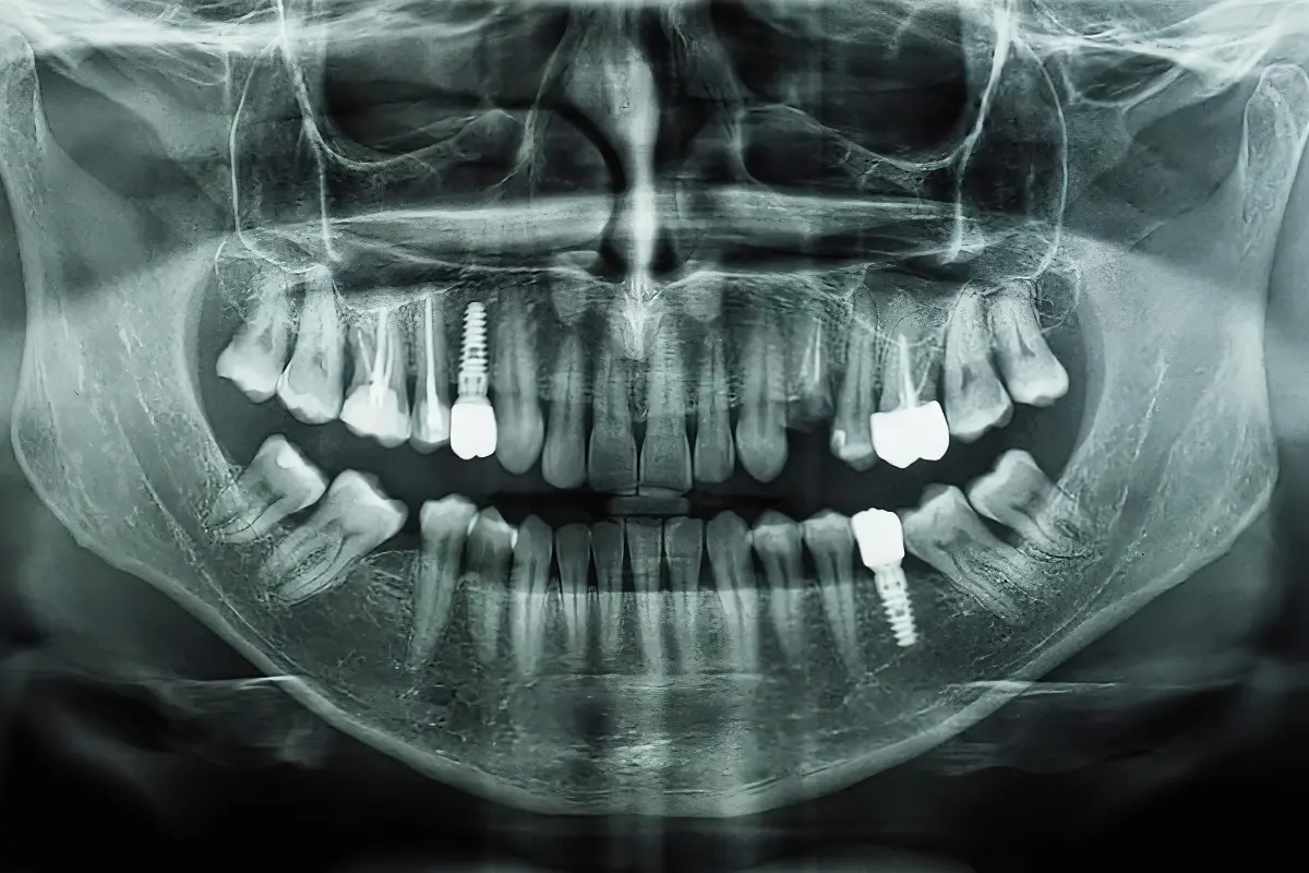 Imagen radiológica de dientes, raíces y estructuras orales