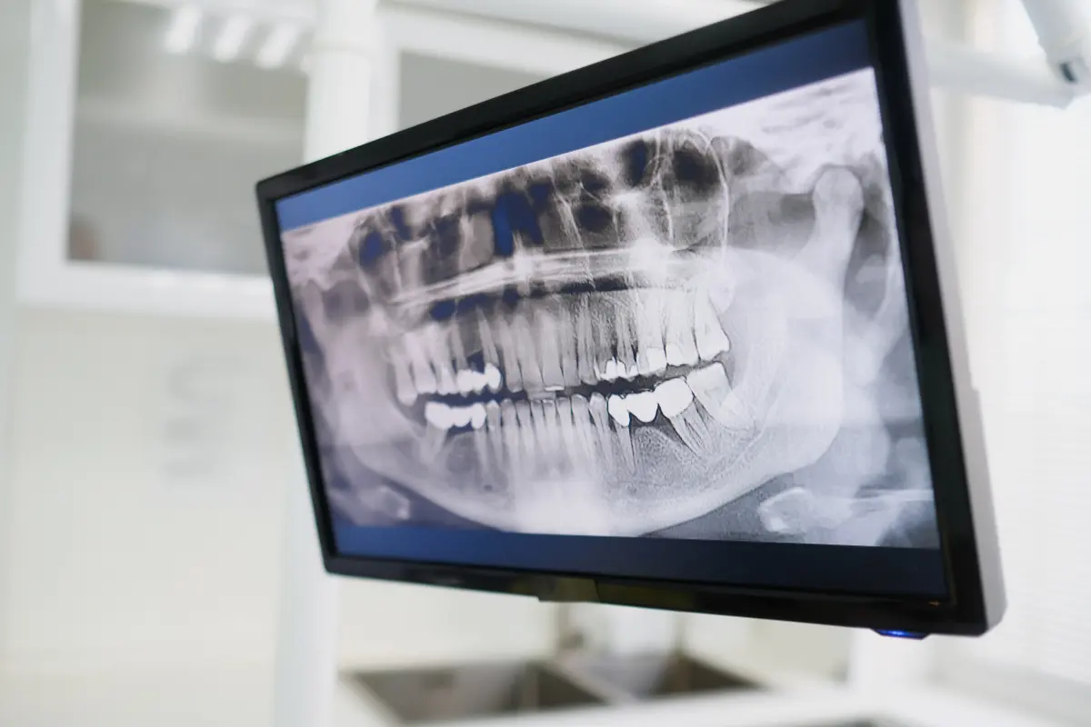 Radiografía extraoral panorámica de dientes y maxilares