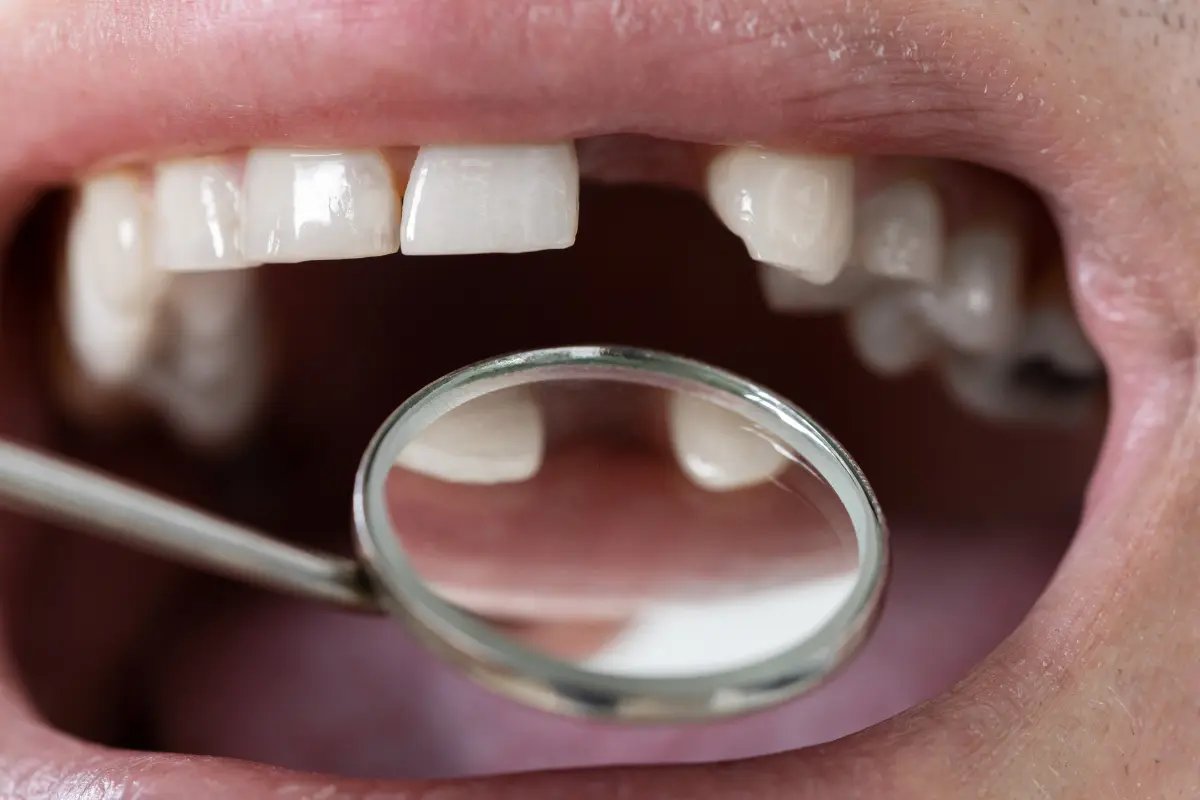 Prótesis dental parcial para recuperar dientes perdidos