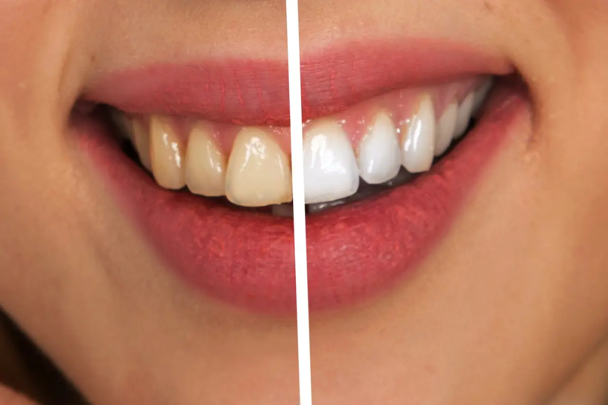 Comparación del color dental antes y después de un tratamiento estético